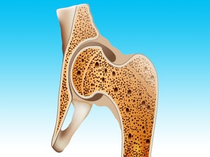 Younger Gynecologic Cancer Patients at Risk for Early Bone Loss