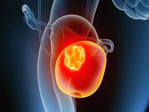 Bladder Cancer Need Not Always Require Radical Cystectomy