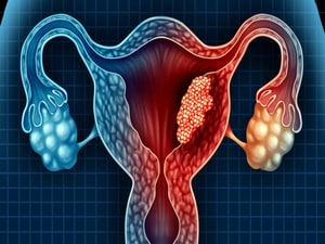 Weight Loss Intervention Fails in Endometrial Cancer Survivors