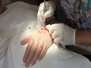Topical Tranexamic Acid Reduces Bleeding Following Mohs Surgery